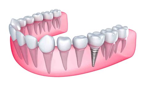 oi vy. . Does masshealth cover dental implants